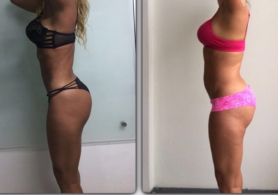 Slim Láser, la mejor opción para ti.
