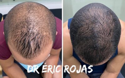 Elimina la alopecia de tu vida.