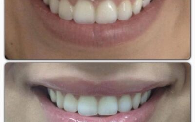 Relleno de labios en Promoción.
