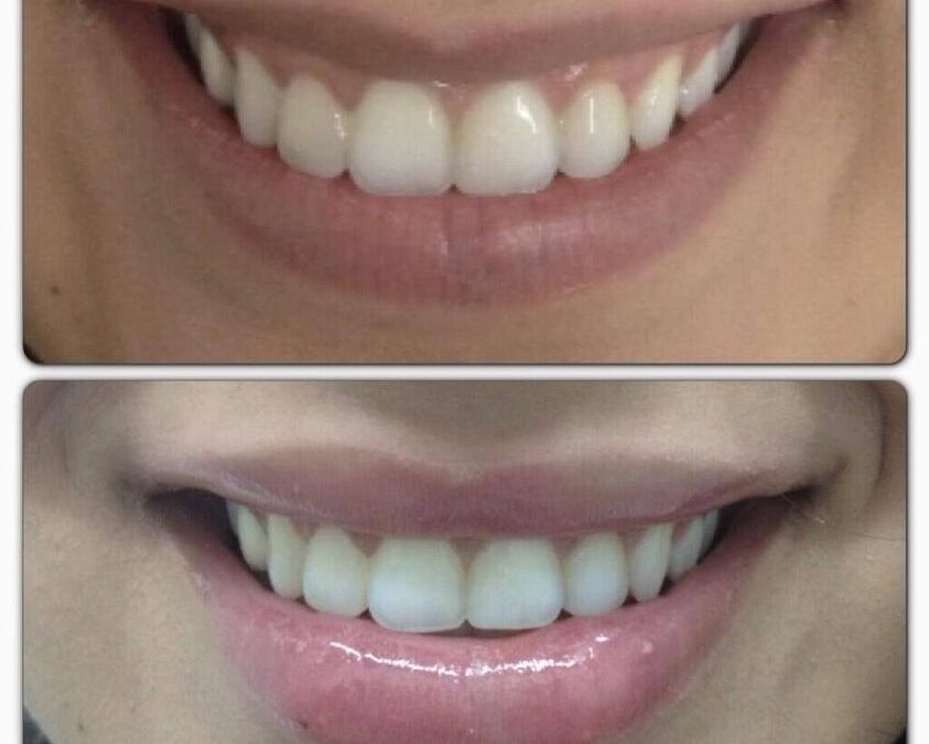 Relleno de labios en Promoción.