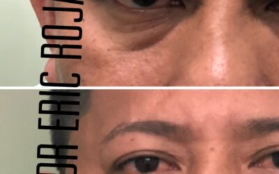 Rejuvenece tu rostro con las mejores técnicas.