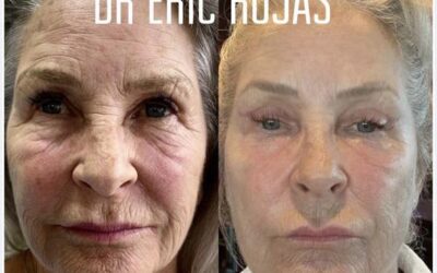 Rejuvenecimiento facial, quítate años de encima con este increíble método.