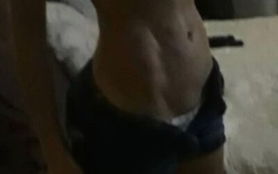 Slim Láser después de 6 años increíble Dr Eric Rojas 22483535