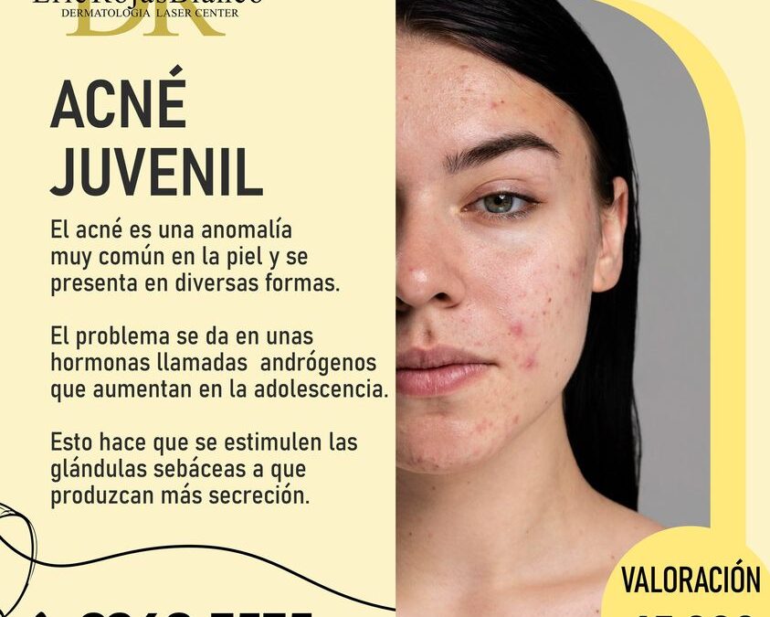 Tratamos el acné juvenil, te esperamos.
