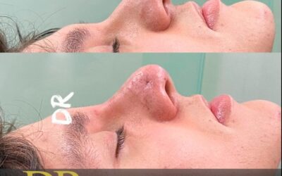 Rinolift, técnica para mejorar punta nasal.