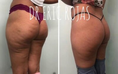 Ya no más celulitis.