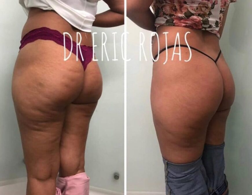 Ya no más celulitis.