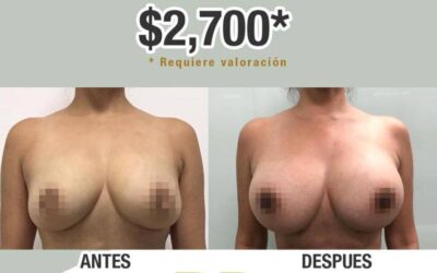 Increíble oferta, aumento de mamas por navidad.