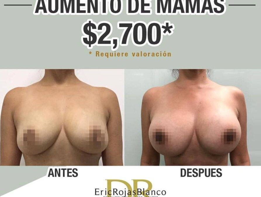 Increíble oferta, aumento de mamas por navidad.