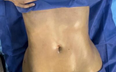 Abdomen Slim Láser finalizado, sin dolor, sin dañar la piel, sin molestias.