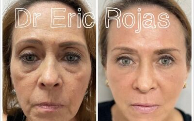 Refrescamiento FACIAL SIN CIRUGÍA