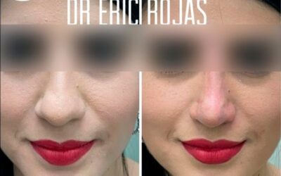 Afinamiento nasal con Rinolift, corrige tu perfil.