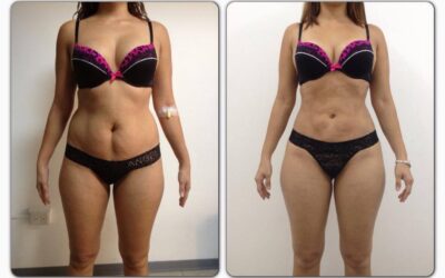 Tu abdomen sin cirugía con Slim láser tratamiento único y exclusivo.