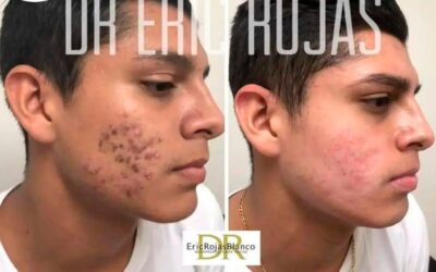 Elimina el acné de tu vida, limpia tu rostro y deja complejos.