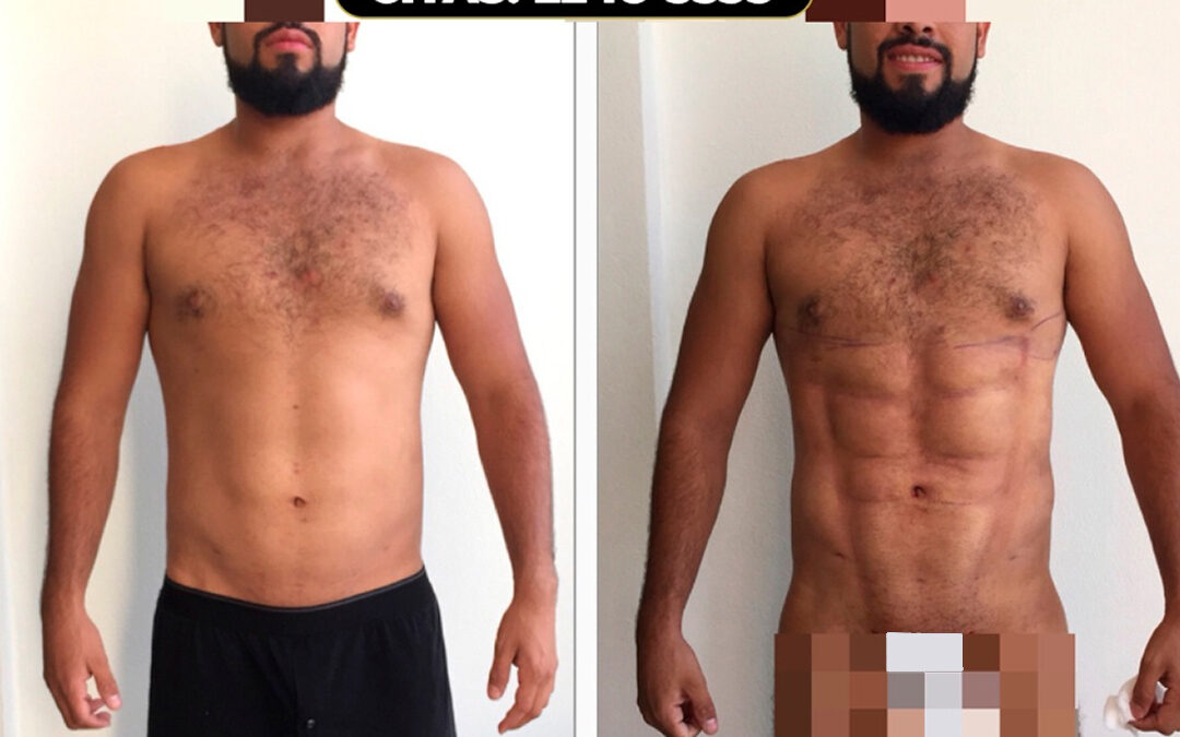 Marcaje Abdominal con Slim Láser.