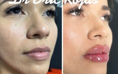 MODELADO DE LABIOS DR ERIC ROJAS 22483535 ahora este mes en 400 dólares