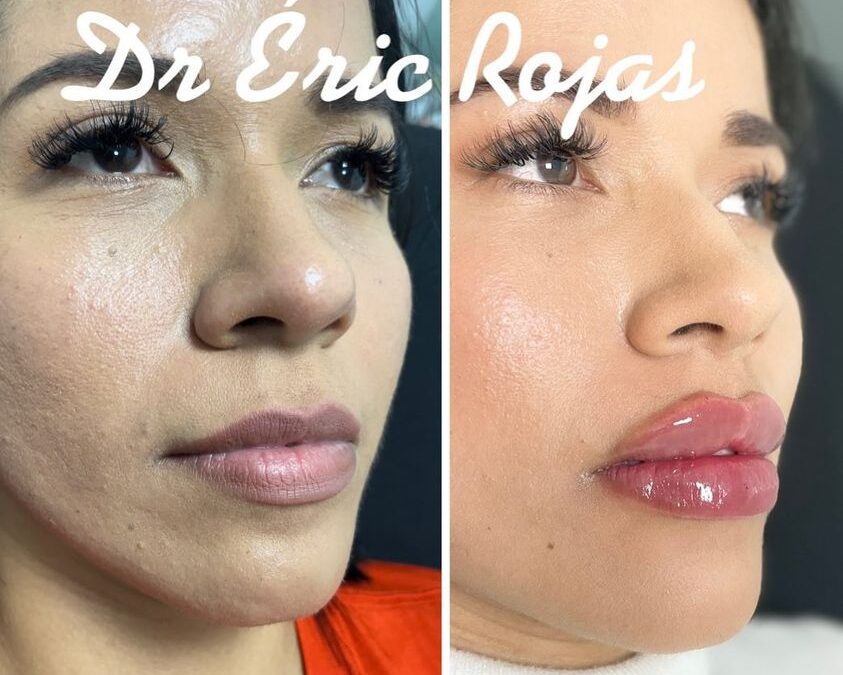 MODELADO DE LABIOS DR ERIC ROJAS 22483535 ahora este mes en 400 dólares