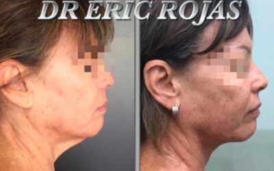 Slim Láser papada, luce genial con un solo procedimiento