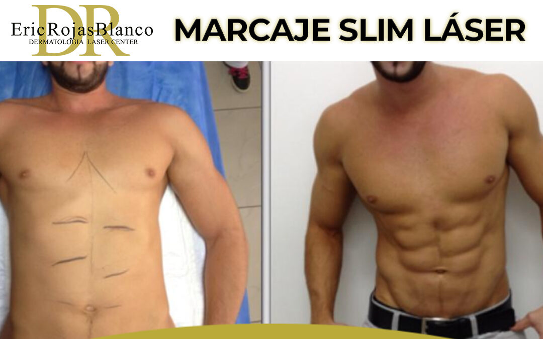 Slim Láser, marcaje completo con la mejor técnica.
