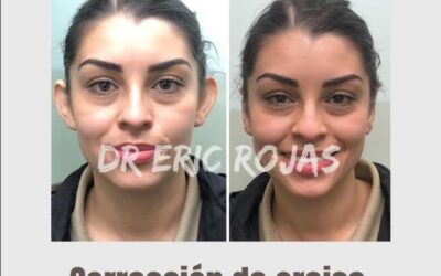 Dermo Otoplastía, la mejor técnica para corregir tus orejas.