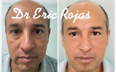 REFRESCAMIENTO GFACIAL DR ERIC ROJAS 22483535