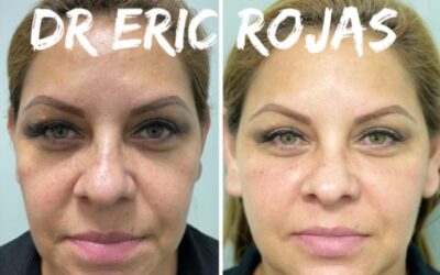 Rejuvenece tu rostro con la mejor técnica.