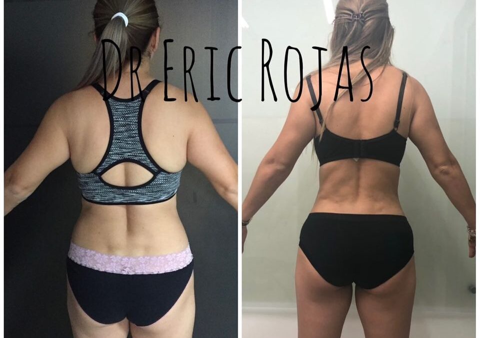 Slim Láser mejora tu cuerpo