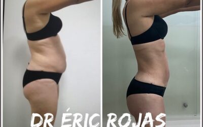 Increíble cambio Slim Láser, las diferencias son notorias.