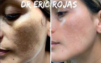 Elimina las manchas de tu rostro, con nuestro increíble procedimiento