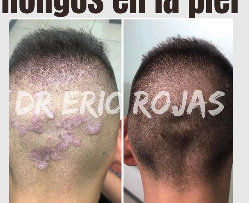 Eliminamos los hongos de tu piel.