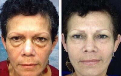 Rejuvenecimiento facial con las mejores técnicas.