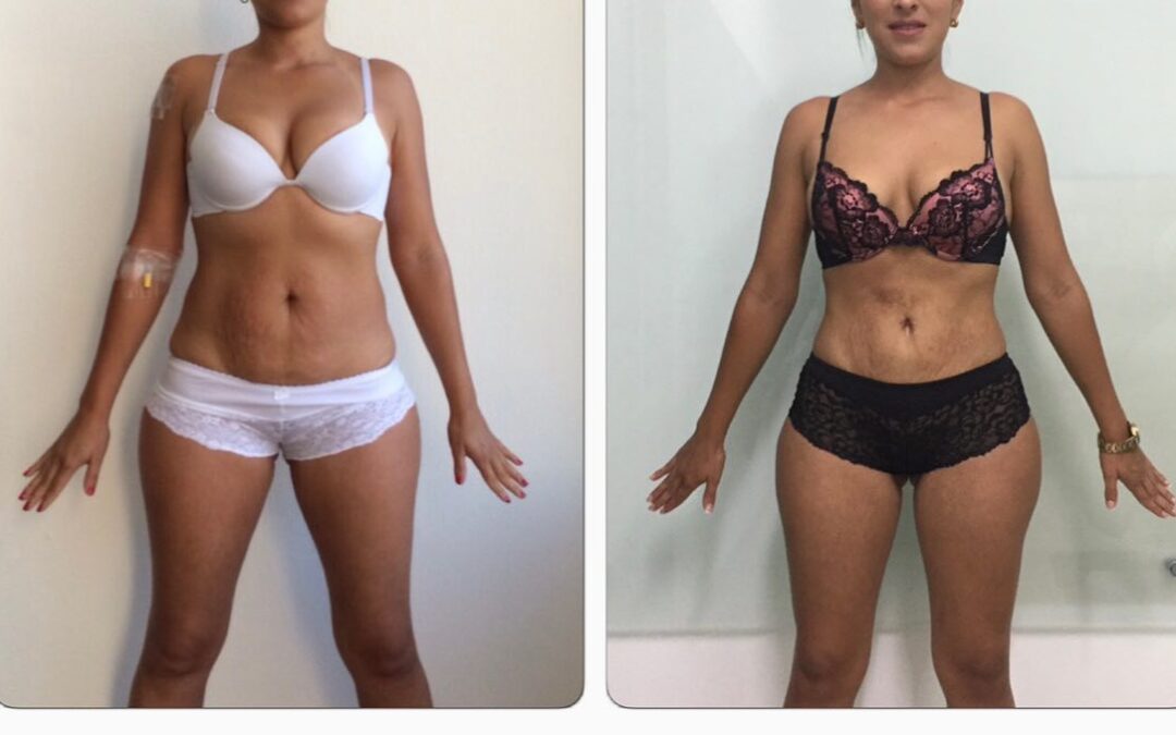 Slim Láser mejora tu cuerpo