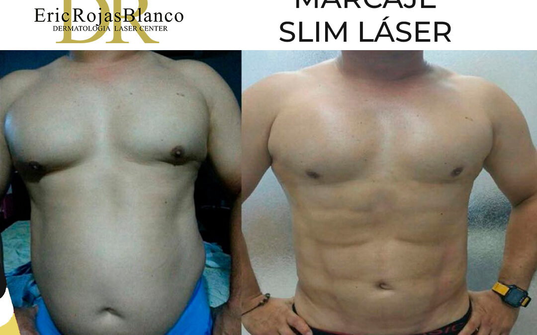 Marcaje con Slim Láser.