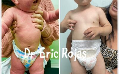 DERMATITIS ATOPICA CONTROLADA Y NIÑO FELIZ DR ERIC ROJAS 22483535