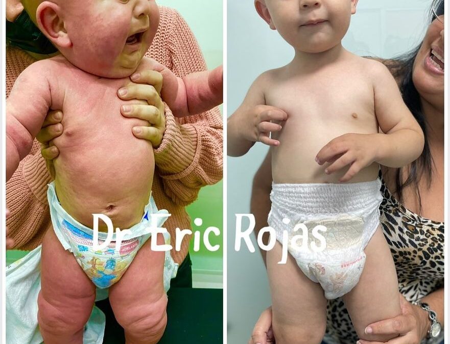 DERMATITIS ATOPICA CONTROLADA Y NIÑO FELIZ DR ERIC ROJAS 22483535