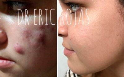 Elimina el acné de tu rostro con el mejor tratamiento del país.