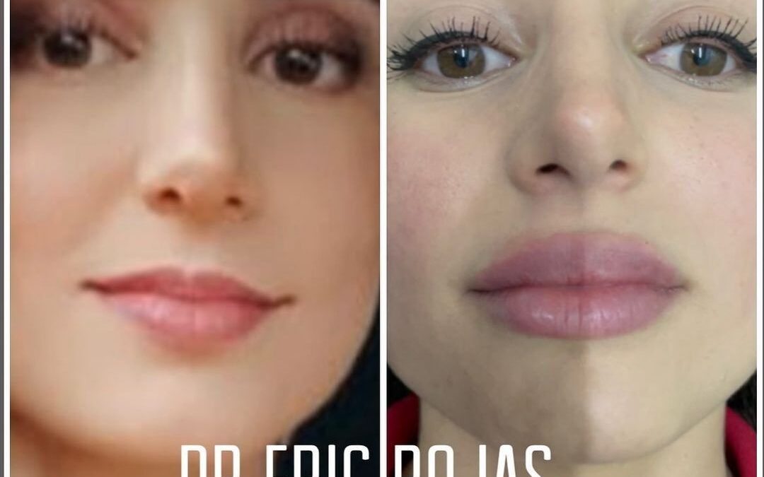 Relleno de labios en $400 dólares.