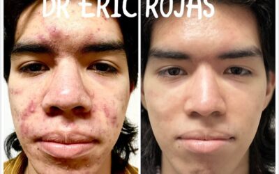 ACNE YA NO MASSSSSS DR ERIC ROJAS 22483535