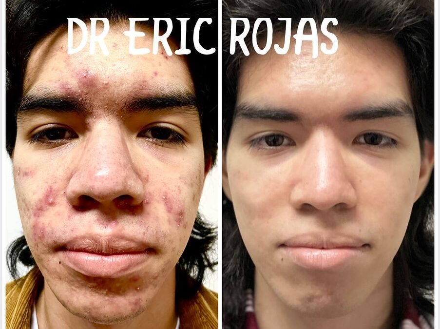 ACNE YA NO MASSSSSS DR ERIC ROJAS 22483535