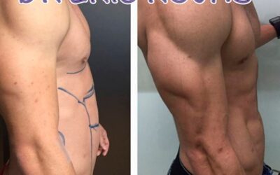 Marcaje con Slim láser, los resultados que podemos obtener son increíbles.