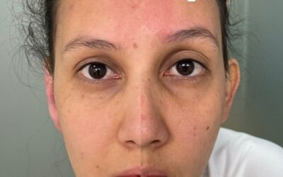Dermo otoplastia DR ERIC ROJAS AHORA EN 950 dólares