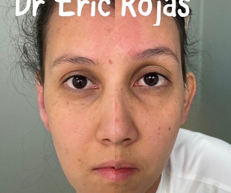 Dermo otoplastia DR ERIC ROJAS AHORA EN 950 dólares