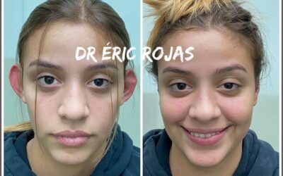 Dermo Otoplastía, corrección de orejas por solo $950 dólares.