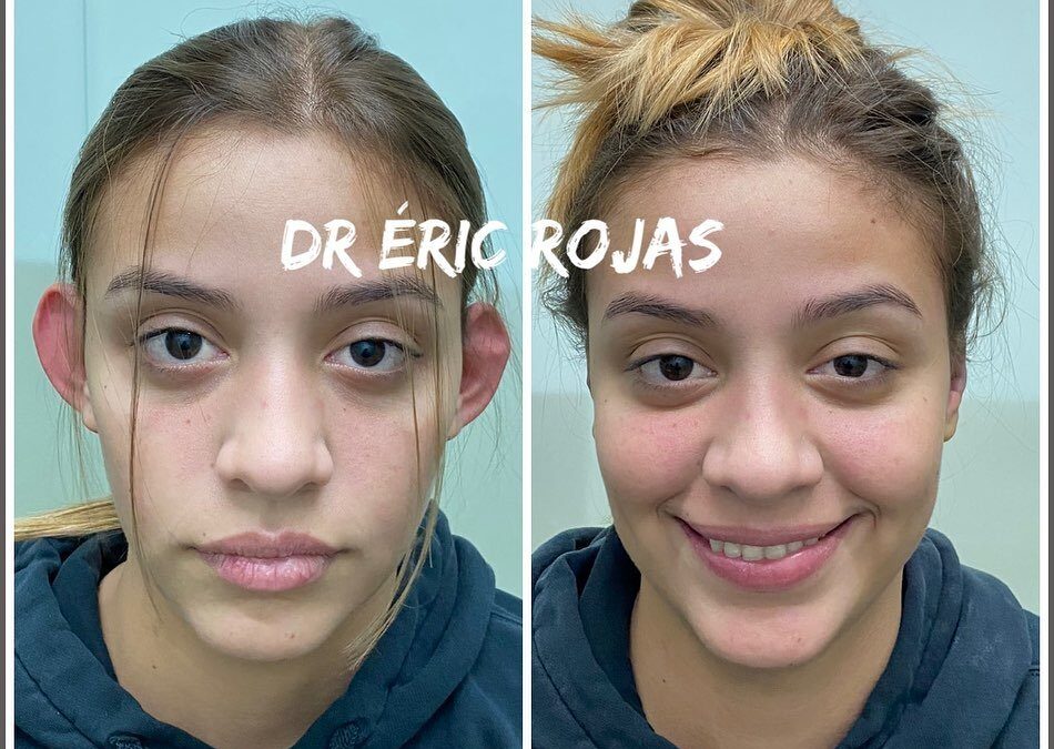 Dermo Otoplastía, corrección de orejas por solo $950 dólares.