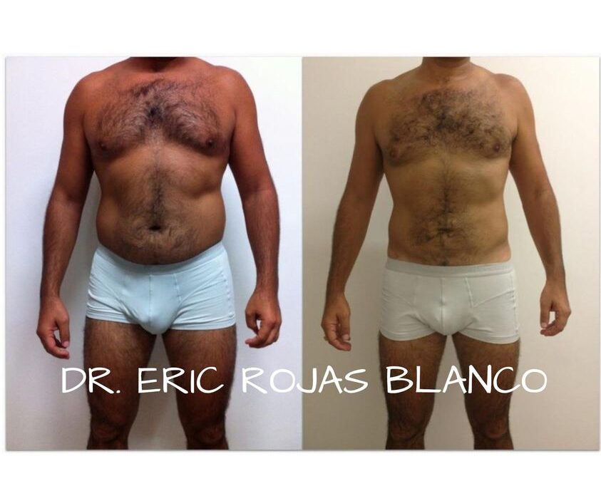 Slim Láser, reducción de abdomen.