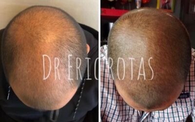 Recupera tu cabello con el mejor tratamiento.