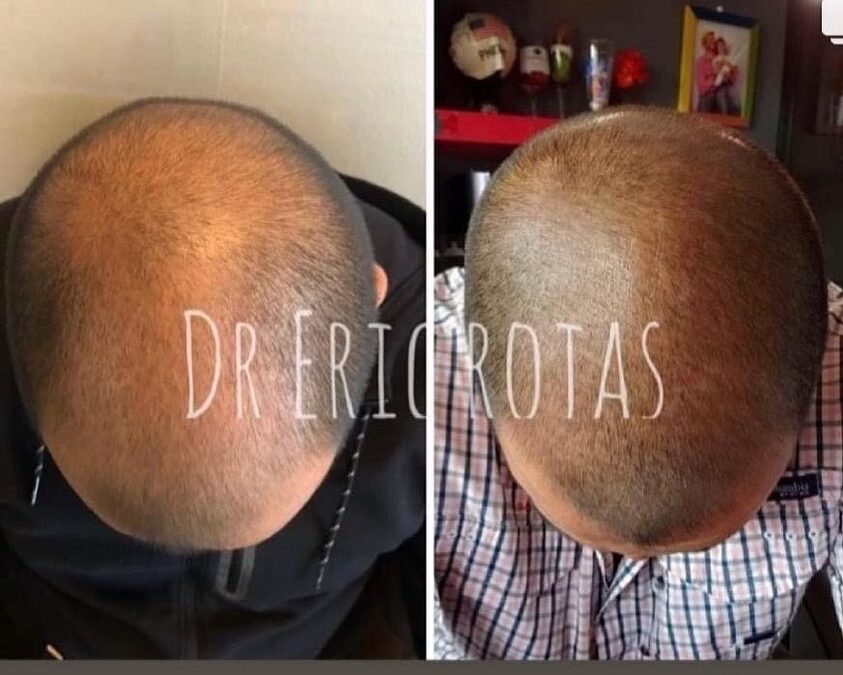 Recupera tu cabello con el mejor tratamiento.