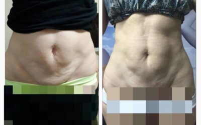 Esa piel sobrante en tu abdomen podemos retraerla con nuestro nuevo láser FOTONA.