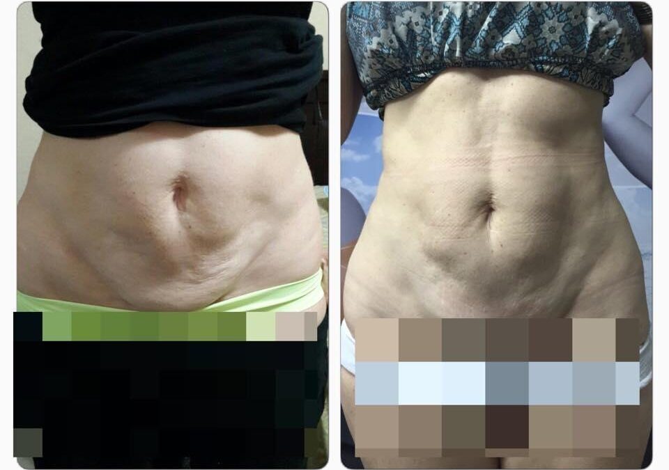 Esa piel sobrante en tu abdomen podemos retraerla con nuestro nuevo láser FOTONA.
