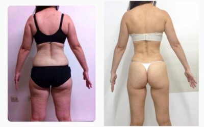 Los mejores cambios los puedes lograr con Slim Láser.